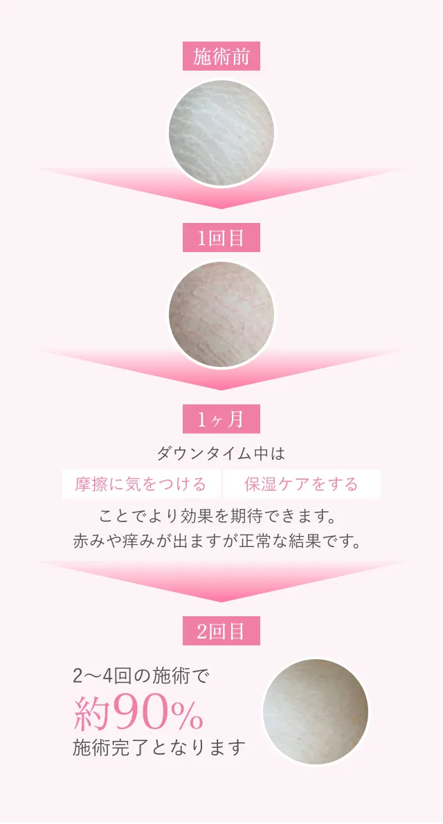 施術回数の写真