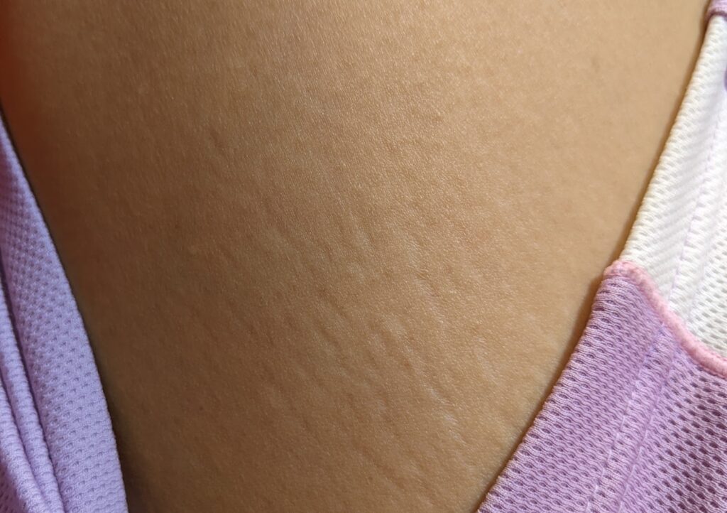 すでにできた妊娠線を改善する4つの方法