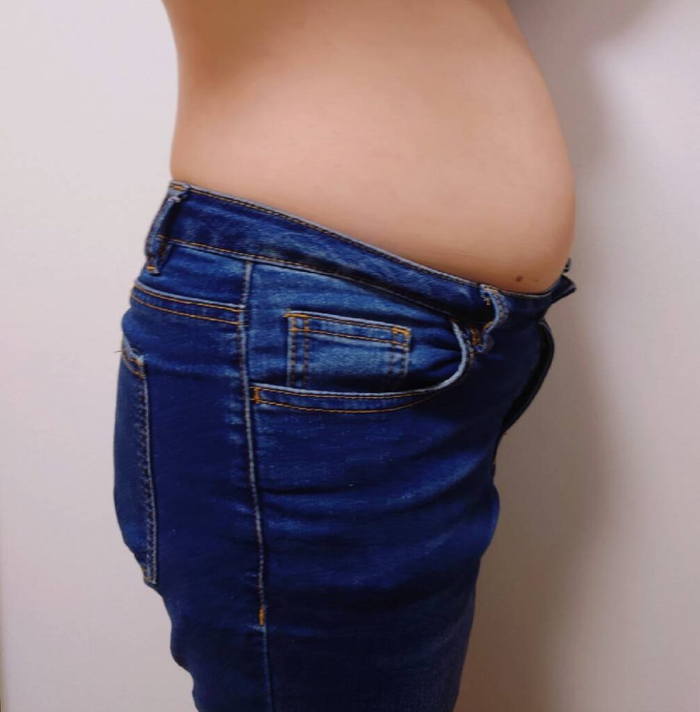 妊娠線は自然に消えるの?放置するリスクや予防法・改善方法を解説