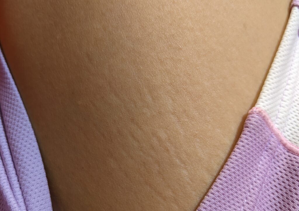 妊娠線を放置する3つのリスク