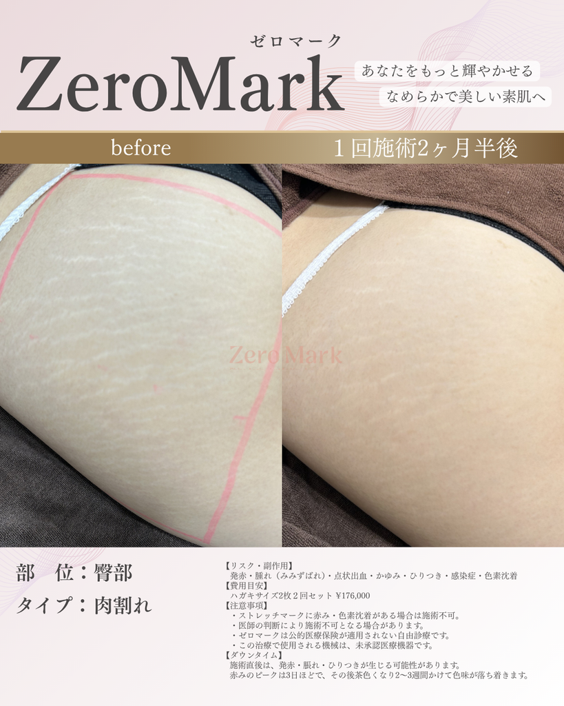 ゼロマークでの施術の症例